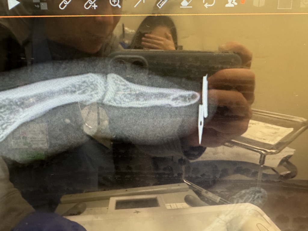 needle through finger